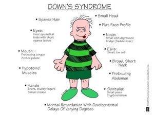 Terapi down syndrome